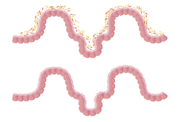 SIBO - syndróm bakteriálneho prerastania čreva